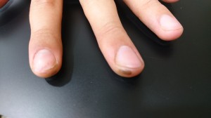 野球爪割れの状態